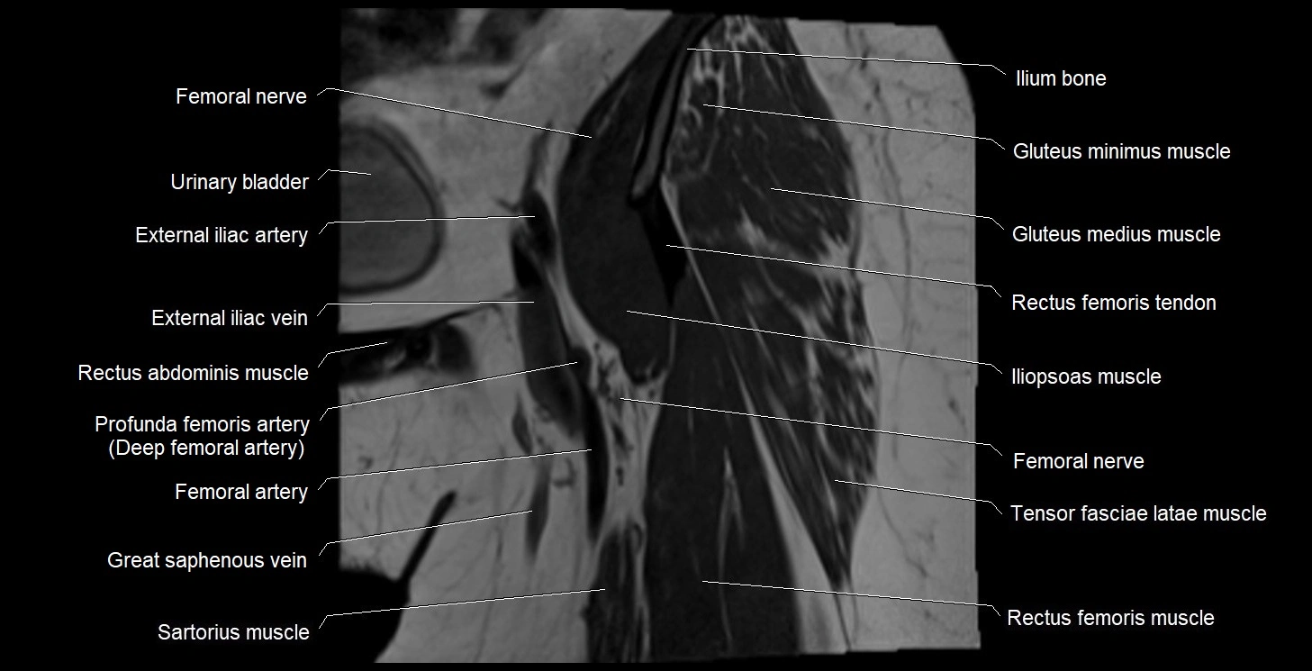 MRI Hip 3T coronal cross sectional anatomy image 11.webp